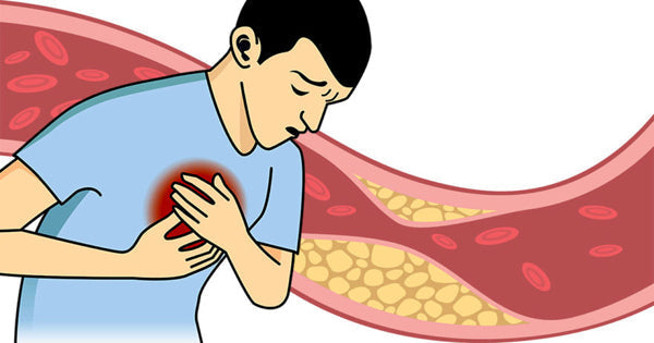Phòng ngừa mỡ máu cao sớm – Điều bạn chưa từng nghĩ tới