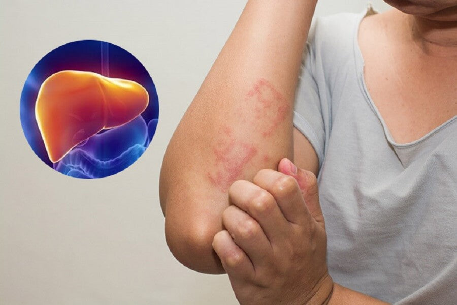 Giải độc gan tại nhà hiệu quả – Linh Chi có thật sự an toàn?